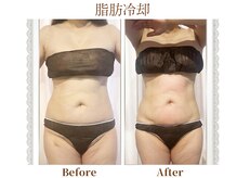 モテスリム/脂肪冷却 お腹4カップ