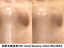 ベリンダ(BELINDA)/毛穴洗浄ハイドロスプラッシュ