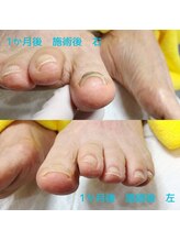 ドクターネイル爪革命 長野店/【巻き爪ケア】ネイル/フット
