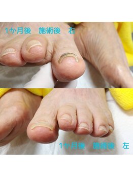【巻き爪ケア】ネイル/フット