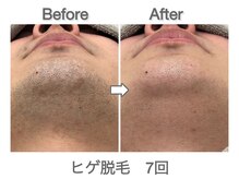 ナルシス/【ヒゲ脱毛】7回の変化★