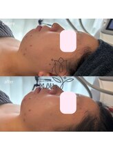 ポムハヌル(pom.haneul)/マイクロ波リフト大阪