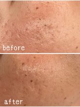 クーレ(CURE)/最強肌改善プラズマジェット