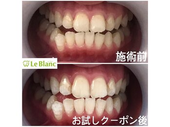 ルブラン 奈良店(Le Blanc)/２回でトーンアップ！