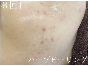 チャーム(Charm)/ハーブピーリング