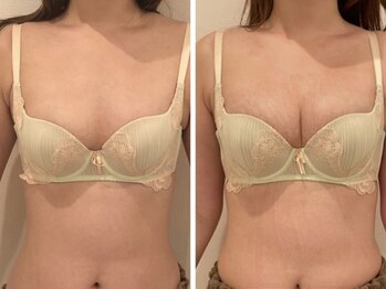 リール 恵比寿店(RIRE)/バストアップ症例【広尾恵比寿】