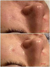 ケードット カシェットプラス(K.CACHETTE+)/毛穴洗浄　ビフォーアフター