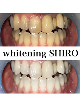 福岡ホワイトニングシロ 天神中洲店(福岡ホワイトニングSHIRO)/【ホワイトニング】before/after