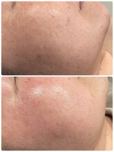 ニコリ(Nicori)/ハーブピーリング光フェイシャル