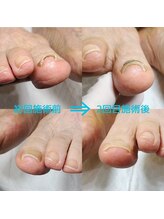 ドクターネイル爪革命 長野店/【巻き爪ケア】ネイル/フット