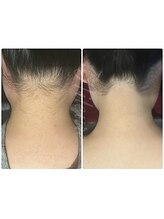 エルール トータルビューティ(Aileure total beauty)/うなじ脱毛　うなじ美人