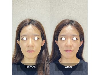 ウル(ulu)/たるみ、くすみには美容鍼