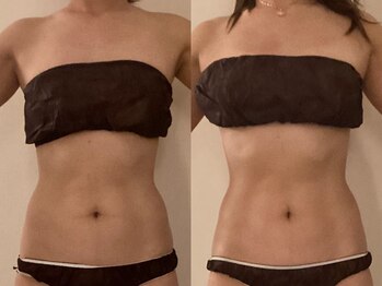 ミオン(美温)/医師監修の腸もみ