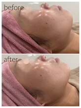 ペルボヌール 深井店/REDSHOT1回(施術直後)