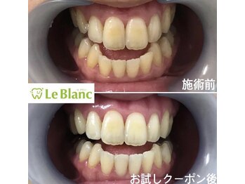 ルブラン 奈良店(Le Blanc)/ホワイトニングするなら当店へ!