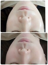 エムブルーム(m-bloom)/艶肌ハーブピーリング