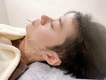 はりきゆうチッタ 自由が丘(はりきゆうCiTTa)/メンズ美容鍼灸