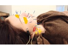 ノゾミ(Nozomi)の雰囲気（【美容鍼】少しでも理想の顔に☆引きしめ効果大！！）