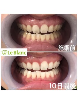 ルブラン 奈良店(Le Blanc)/お休みを利用して白く!