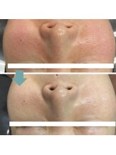 レベンディス(LEVENDIS)/ハーブピーリング