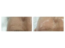 トリアングル(TLIENGLE)/ララピール　before　after