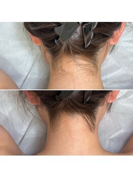 インベスト(INVEST)/うなじ脱毛