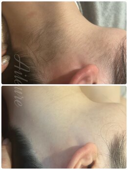 エルール トータルビューティ(Aileure total beauty)/うなじ脱毛 うなじ美人