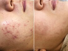 ハダイ(HADAY)/ニキビ改善｜ハーブピーリング