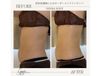 エスプリ(Esprit+)/●インディバ施術効果