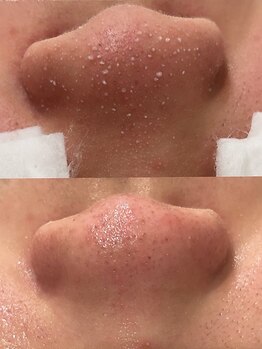 ラルガ 小倉北区魚町本店(Raruga)の写真/【ご新規様限定】毛穴ケア+ワックス(鼻)1回＋鎮静パック付￥3000★お得なクーポンでお悩み解消♪