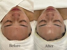 リフコウベ(LIF KOBE)/艶肌wax+ハーブピーリング1回