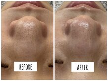 ハオン(HAON)/毛穴洗浄×ハーブピーリング