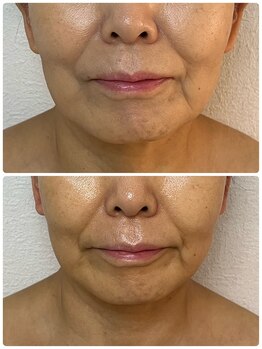 ルミア(LUMIA)/小顔造形ロイヤル