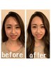 ★院長施術【小顔×たるみ特化】美容鍼コース 10,000円