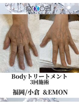 アンドエモン(&EMON)/【ボディ】プロセル効果