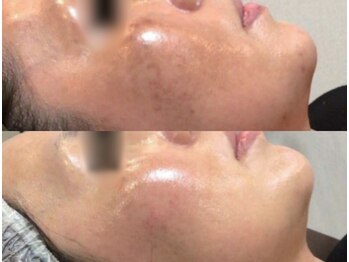 ミレット(Miretto)の写真/美白特化の乳酸ピーリング!「シミ・色トラブル」を根本からケア。シミを作らせない透き通る美肌へ!!