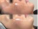 ミレット(Miretto)の写真/美白特化の乳酸ピーリング!「シミ・色トラブル」を根本からケア。シミを作らせない透き通る美肌へ!!