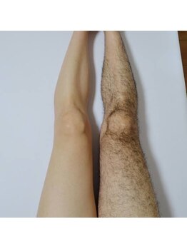 リュミエール デスポワール(Lumiere d'espoir)/脱毛