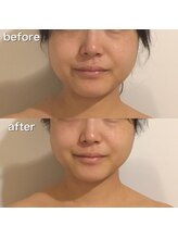 モモスパ(MOMOspa.)/頭蓋骨小顔矯正ビフォアフター