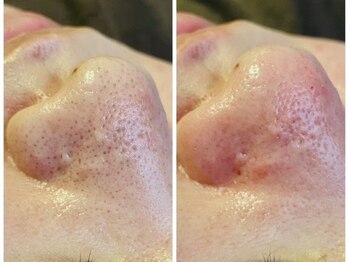 エスサロン(S.salon)/ハイドラフェイシャル