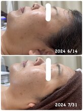 ル シェリア(Le Cherien)/筋膜リリースで小顔造形