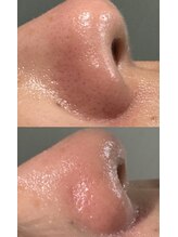 アローナ(ARONA)/1回でこの変化！