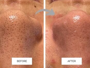 リンネ(Rin'ne)/【1回の効果】毛穴洗浄