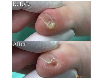 巻き爪補正店 豊田店/【副爪ケア】