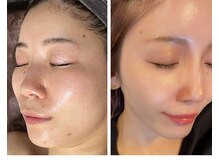 フェイスプラスリフ(FACE+RiF)/本格の肌質改善★【SERMENT】