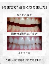 エミリアホワイトニング(EMIRIA WHITENING)/今までで1番白くなりました☆
