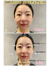 ヒーレンス(HEALENCE)/EMS小顔30分でここまで変わる！