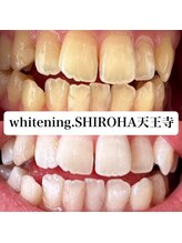 シロハ(SHIROHA)/セルフホワイトニング/天王寺