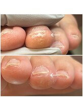 リネイル 長浜(Re-na-iL)/フット角質ケア¥5900