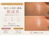【皮脂毛穴対策】ざらつに毛穴・ニキビケア(顔脱毛付)34980→